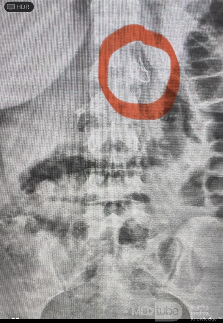Renal Cyst Aspiration