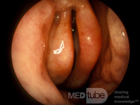 Anteriorly Bent Uncinate Process