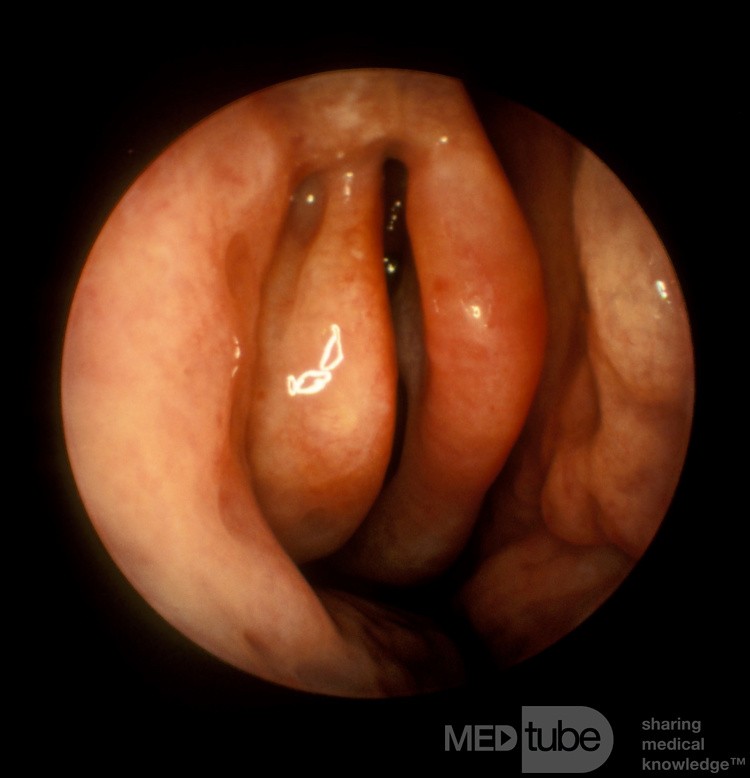 Anteriorly Bent Uncinate Process