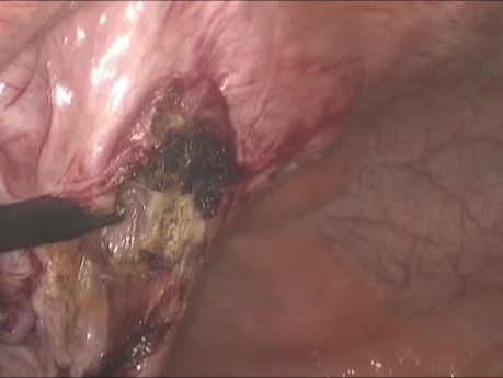 Laparoscopic treatment of umbilical hernia