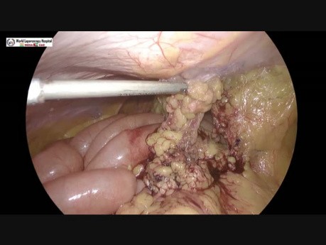 Laparoscopic Repair of Recurrent Umbilical Hernia