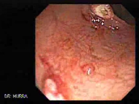 Polypectomy of Stalked Polyp (6 of 6)