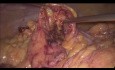 Laparoscopic Right Hemicolectomy with Intracorporal Anastomosis in a BMI 52 Patient