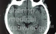 The Hyperdense Middle Cerebral Artery Sign