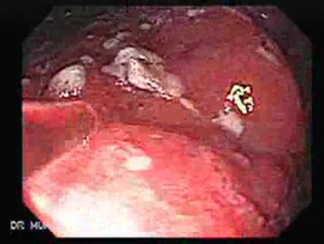 Non-Hodgkin B-Cell Lymphoma - Assessment of the Lesions, Part 2