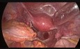 Laparoscopic Colectomy