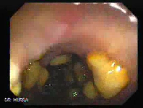 Pseudomembranous Colitis (8 of 11)