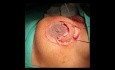 Breast Oncoplasty: Different Volume Displacement Techniques for Breast Cancer