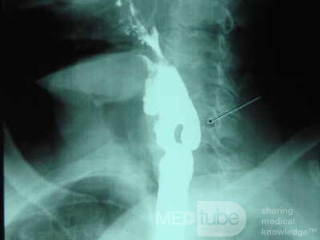Zenker's Diverticulum  (8 of 8)