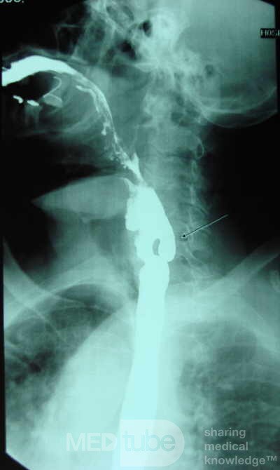 Zenker's Diverticulum  (8 of 8)