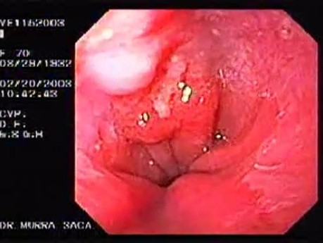 Barrett's Ulcer (1 of 5 )