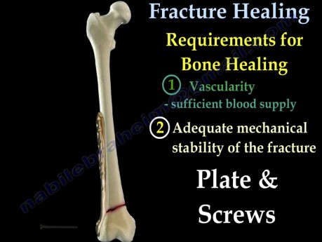 Fracture Healing - Video Tutorial - Part 1