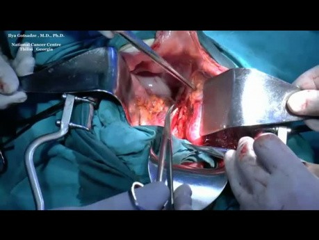Surgery for Retroperitoneal Malignant Fibrous Histiocytoma of Ileac Region