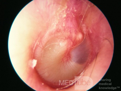Early Acute Otitis Media [the stage of suppuration]