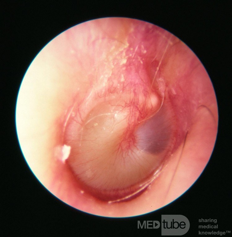 Early Acute Otitis Media [the stage of suppuration]