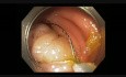 Colonoscopy - Cecum Pedunculated Polyp Resection