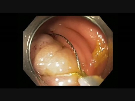 Colonoscopy - Cecum Pedunculated Polyp Resection