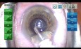 Cataract Surgery in a 19mm Eye