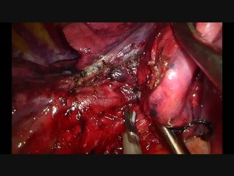 Subxiphoid Uniportal VATS middle lobectomy