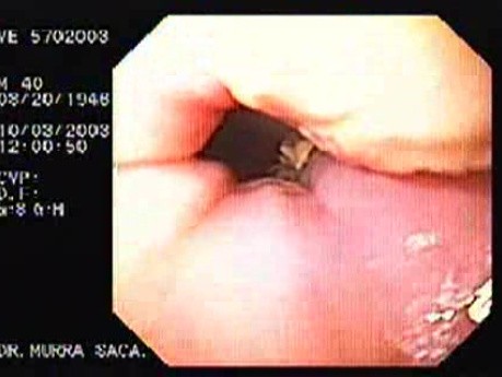 Acute Variceal Bleeding - Follow Up 7 Days After Banding