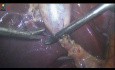 Cystic Duct Control with Suture Ligation