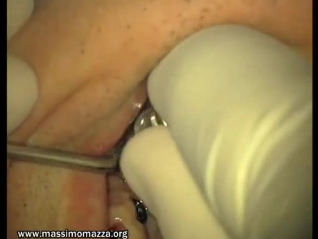 Loading Of Early Prosthesis 16-17-25-26-27 (2/3)