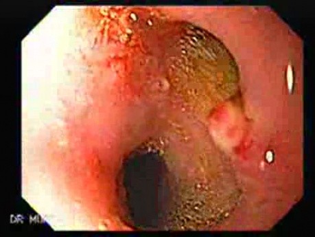 Choledocoduodenostomy and The Sump Syndrome (3 of 10)