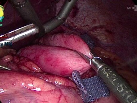 Shoe Shine Maneuver in Nissen Fundoplication