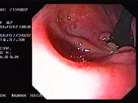 Crohn´s Disease (27 of 28)
