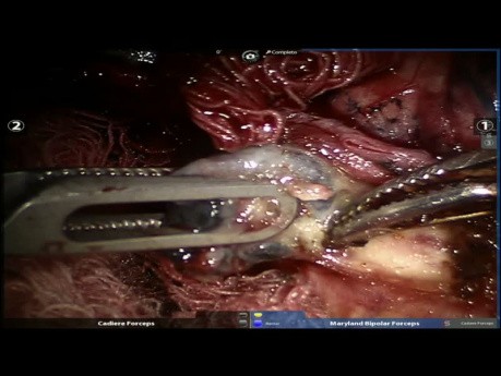 Robotic Left Upper Lobectomy
