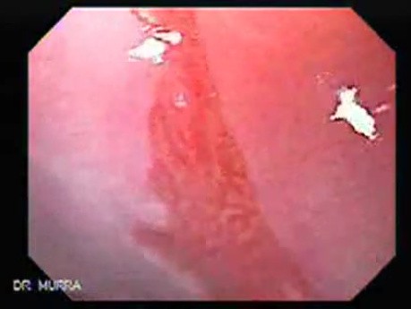 Barrett Esophagus - endoscopic view  (2 of 9)