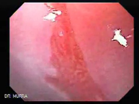 Barrett Esophagus - endoscopic view  (2 of 9)