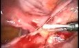 Laparoscopic Lysis Of Adhesions After Pelvic Inflammation Disease