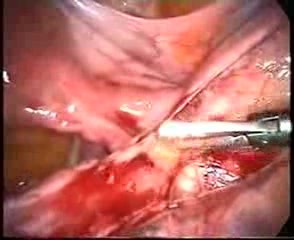 Laparoscopic Lysis Of Adhesions After Pelvic Inflammation Disease