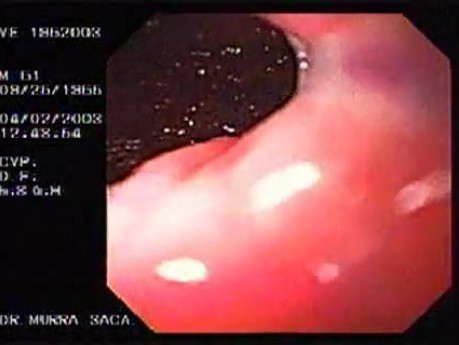 Banding of esophageal varices (14 of 17)