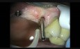 Replacement of a Dental Implant Healing Cap
