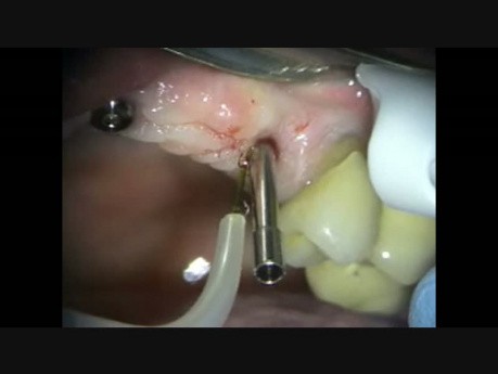 Replacement of a Dental Implant Healing Cap