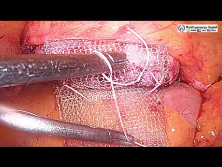 Sacrocolpopexy in Patient with Severe Adhesion