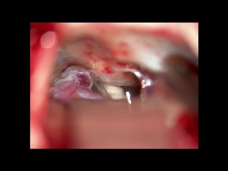 Trigeminal neuralgia