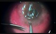 Management of Advanced Steroid Glaucoma in a Case of Severe Cernal Catarrh of Bulbar Variety