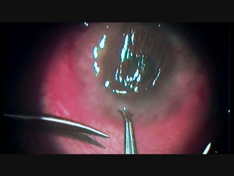 Management of Advanced Steroid Glaucoma in a Case of Severe Cernal Catarrh of Bulbar Variety