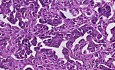 Adenocarcinoma - Histopathology of ovary