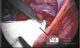 Laparoscopic Inguinal Hernia Repair
