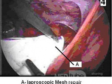 Laparoscopic Inguinal Hernia Repair