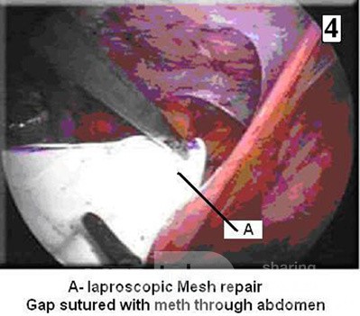 Laparoscopic Inguinal Hernia Repair