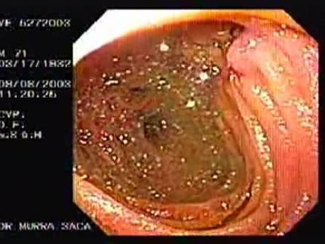 Esophago-Jejunostomy Roux-en-Y (5 of 6)