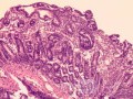Duodenal Mucosa in Celiac Disease (5 of 6)