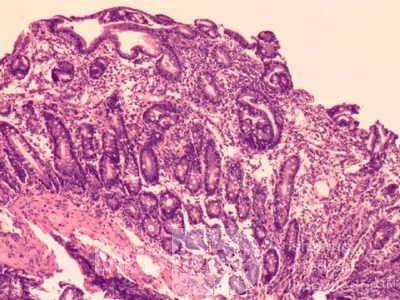 Duodenal Mucosa in Celiac Disease (5 of 6)