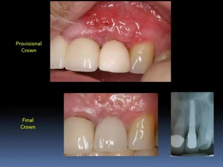 Immediate Implantations For Begginers
