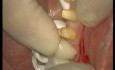 Best Way To Fix Crown - Adhesive Cementation (2/2)
